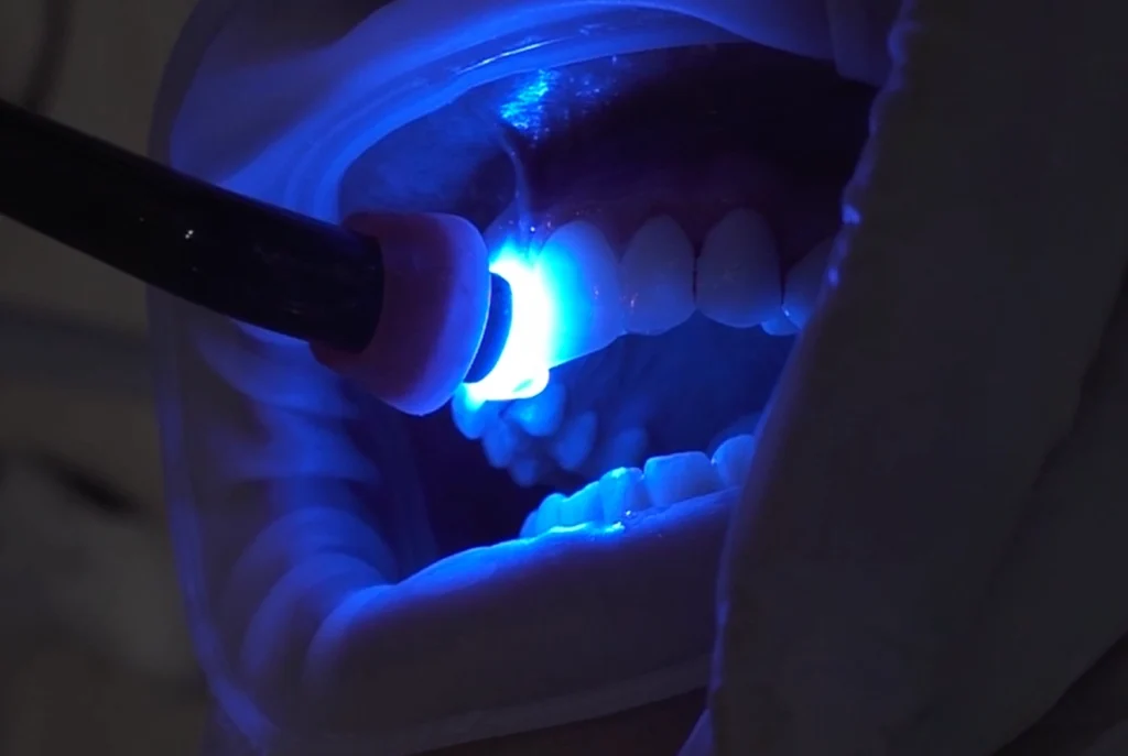 p42-plus-dental-light-curing-procedure